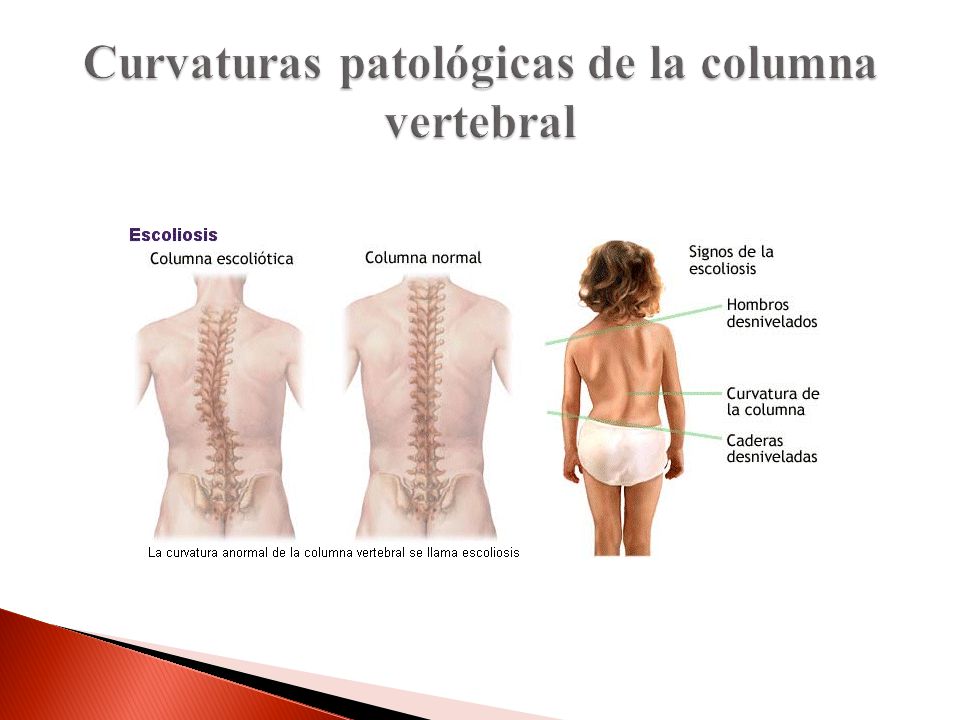 Después del montecillo duele la espalda